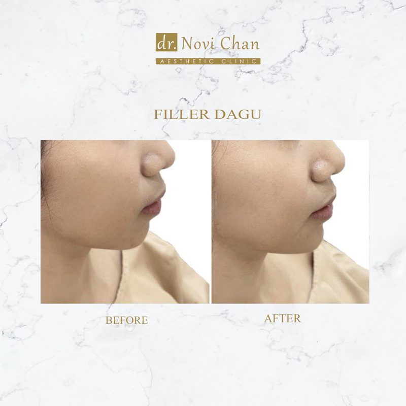 hasil-treament-FILLER DAGU 161021