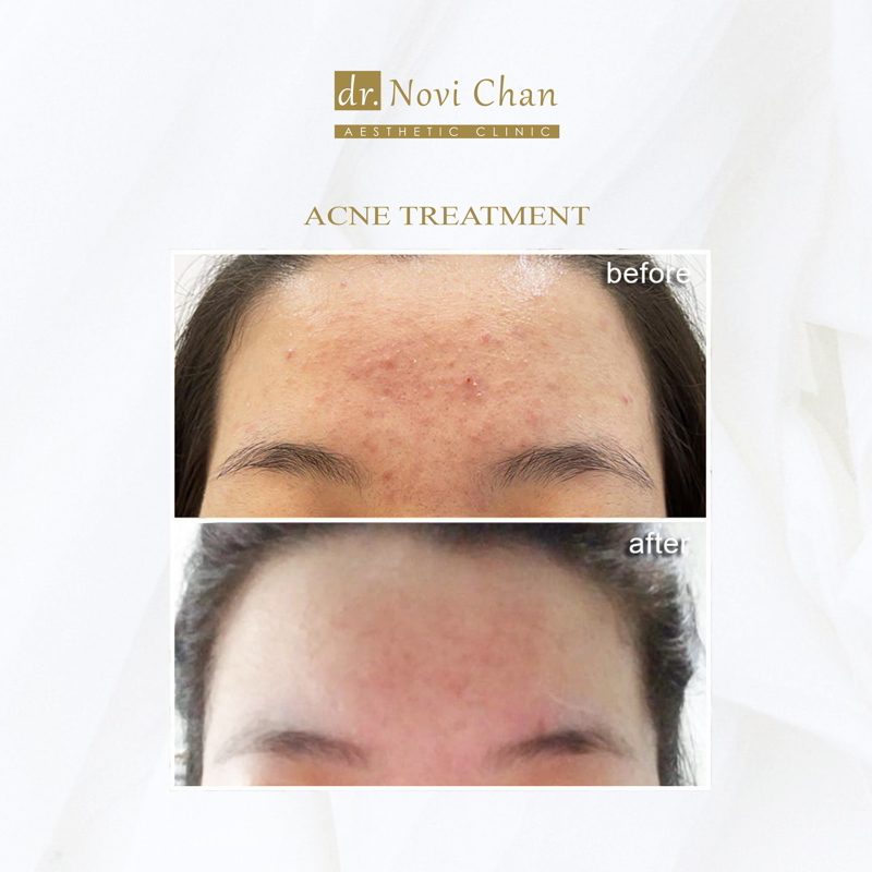 hasil-treament-IG 16921 II