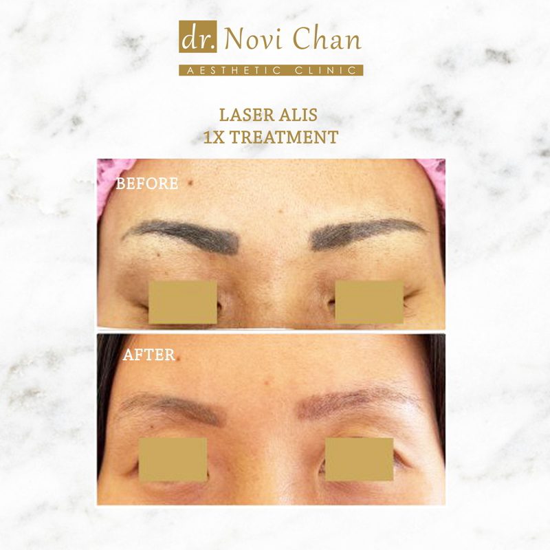hasil-treament-LASER ALIS
