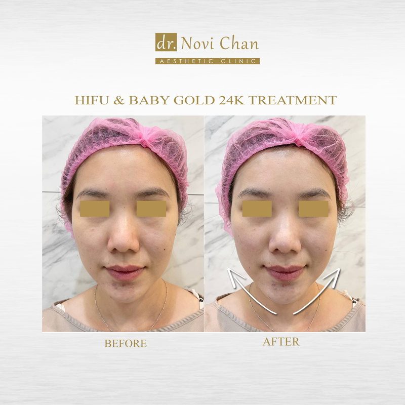 hasil-treament-ig 16921