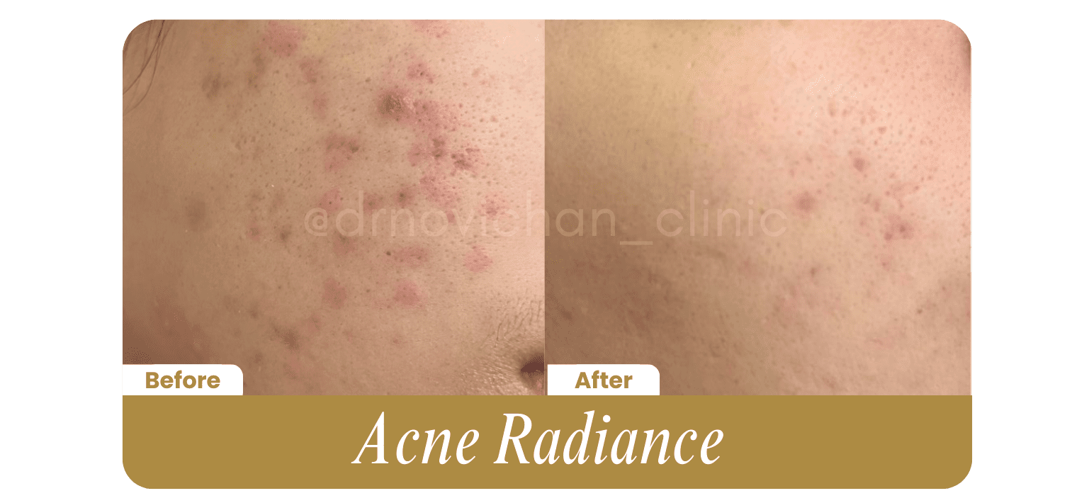 Acne Radiance - Before After DokterNovi_com
