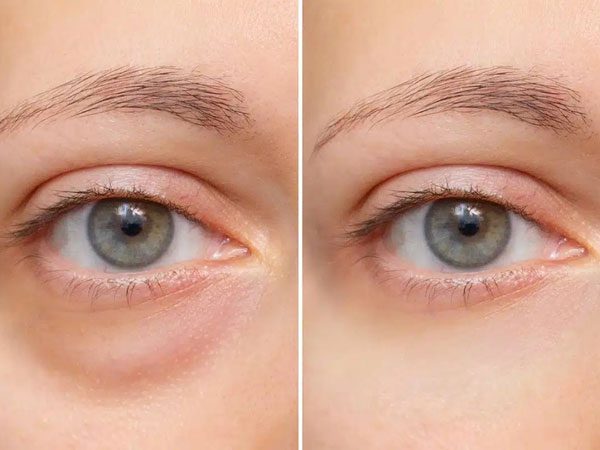 Eyebag Removal Treatment -DokterNovi_com
