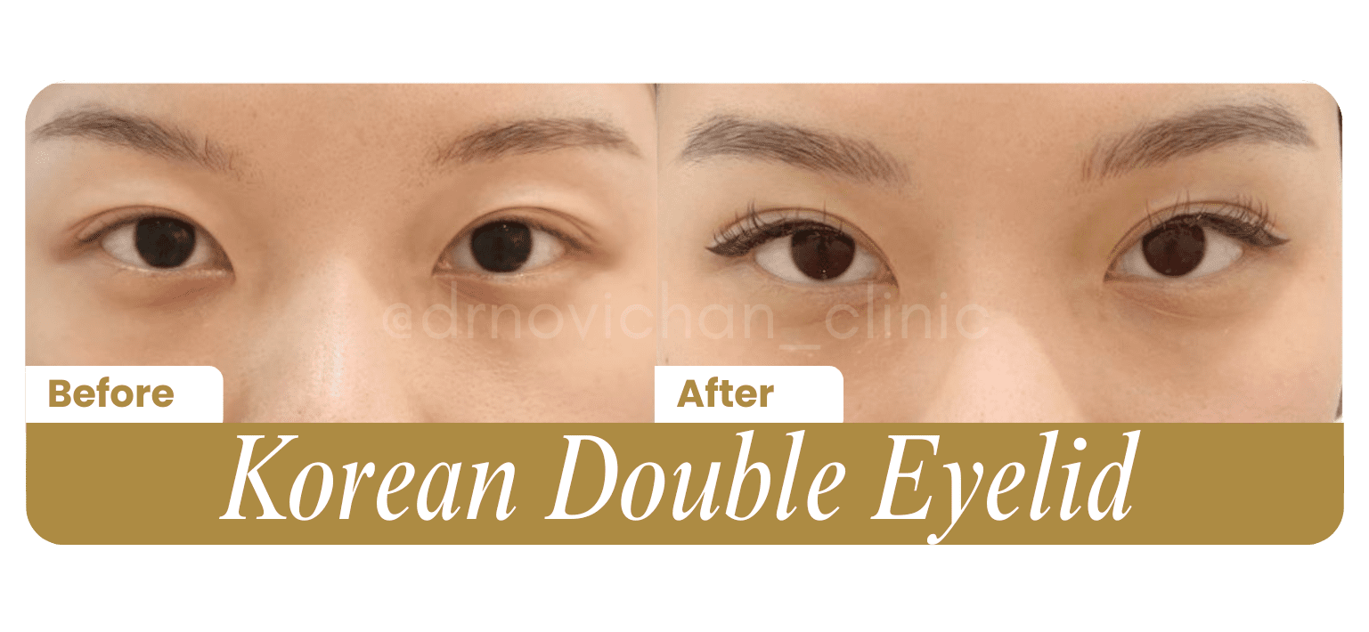 Korean Double Eyelid - Before After DokterNovi_com