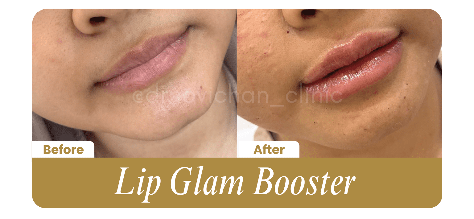 Lip Glam Booster - Before After DokterNovi_com