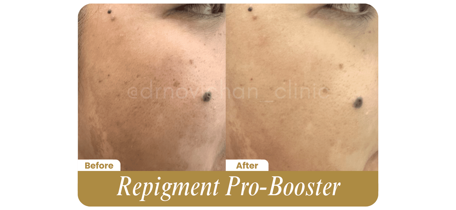 Repigment Pro Booster - Before After DokterNovi_com
