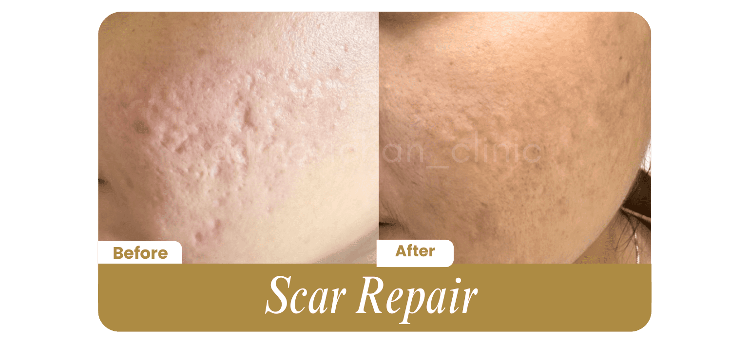Scar Repair - Before After DokterNovi_com