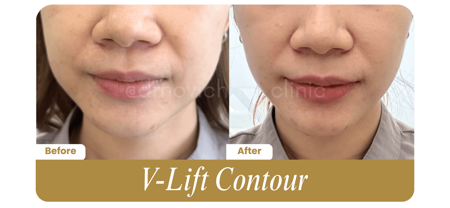 V-Lift Contour - Before After DokterNovi_com