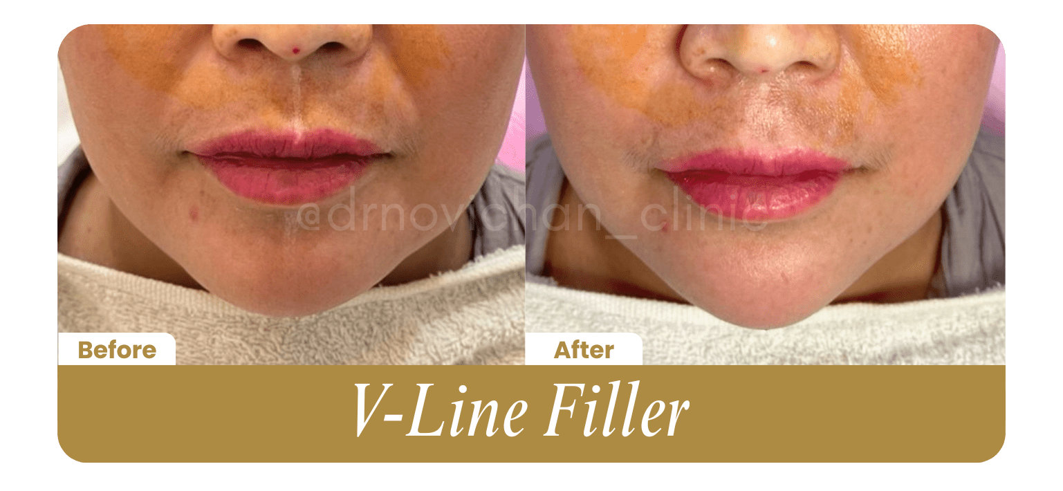 V Line Filler - Before After DokterNovi_com
